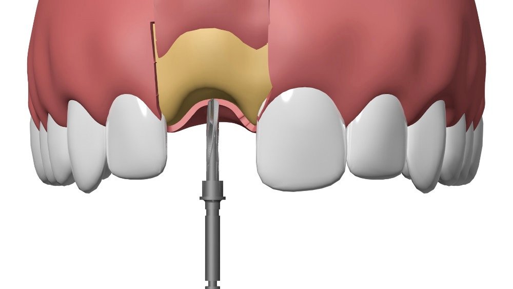 Implant dentaire Nimes cabinet dentaire Nimes